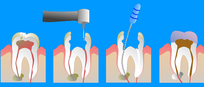 Painless Root Canal In Delhi, Painless Root Canal In India, Painless Root Canal, Dental Clinic India, Best Dental Clinic, Dentist In Delhi, Best Dental Clinic In Delhi, Dr Bhutani Dental Clinic Dr Bhutani Raja Garden, Pitampura, Dental Implant Center