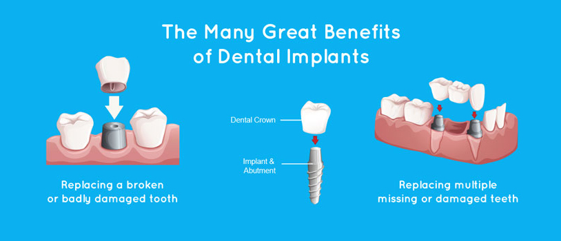 Dental Implants Benefits