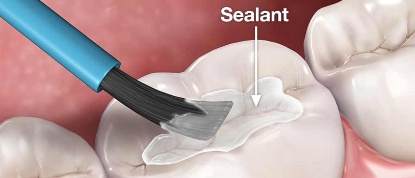 Dental Sealants Treatment In Delhi