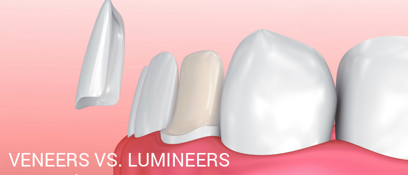 Difference Between Veneers And Lumineers