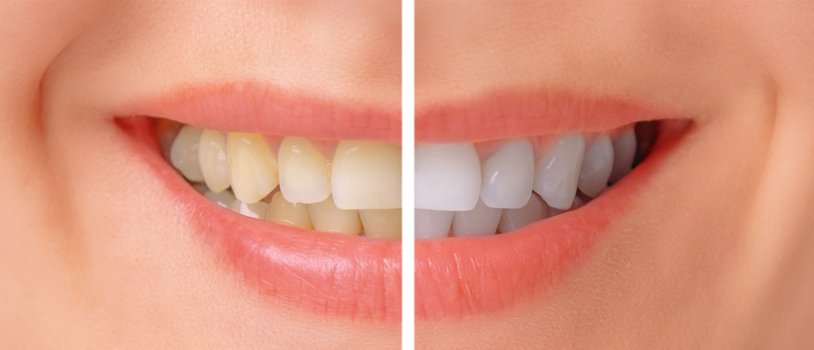 Teeth Whitening Treatment In Delhi, Teeth Doctor In Delhi,