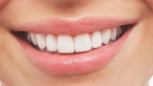 teeth whitening in delhi, teeth cleaning, whitening teeth with braces, best teeth doctor in delhi
