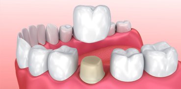 Invisible Braces In Delhi, Dental Clinic In Delhi