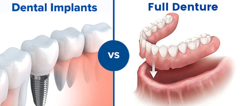 Difference Between Dental Implants Vs. Full Denture