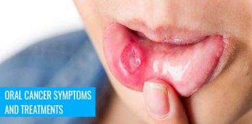 Oral Cancer Symptoms