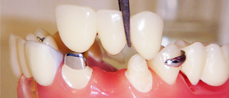 Ceramic Dental Crowns