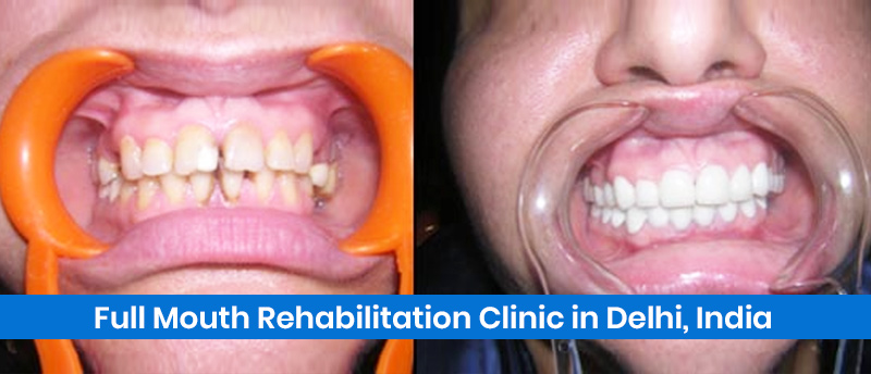 Full Mouth Rehabilitation treatment in India