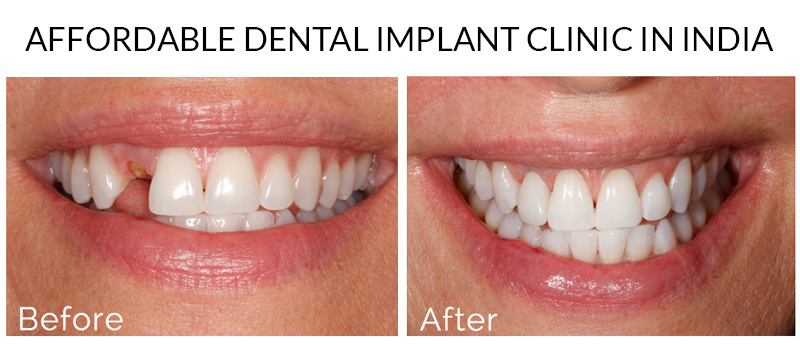 Affordable Dental Implant Clinic In India