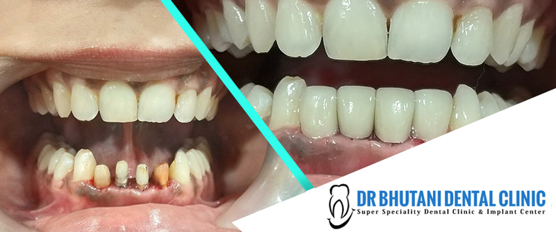 Zirconia Dental Crowns treatment