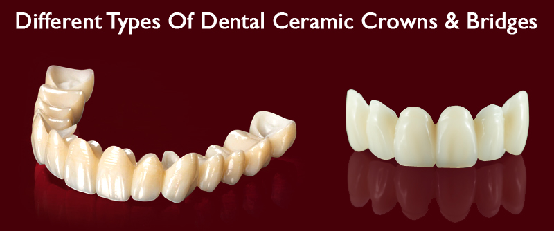 Best dentist in Delhi NCR, Dental bridges, Dental Ceramic Crowns, Dental Treatments,