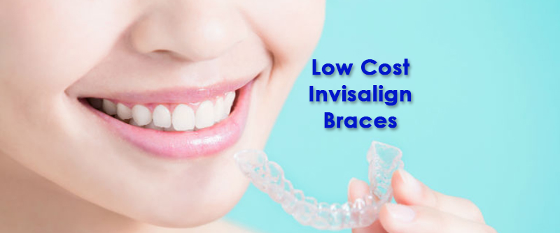 Invisalign Cost in Delhi