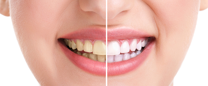 Difference between Teeth Whitening & Bleaching