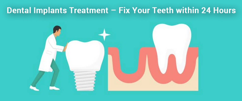 Dental Implants Treatment