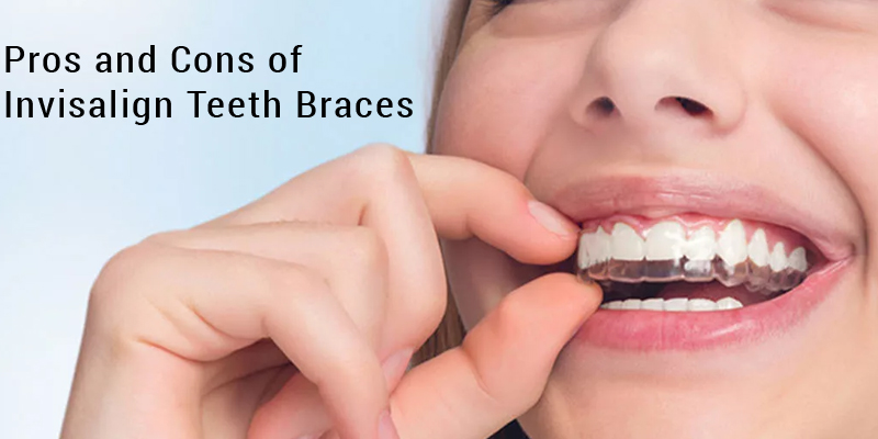 Pros and Cons of Invisalign Teeth Braces