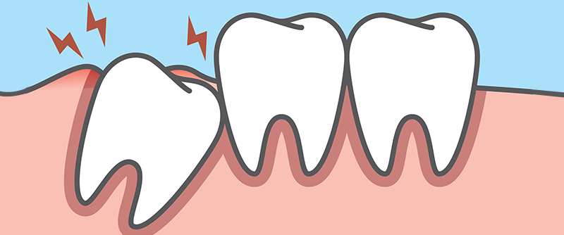 Wisdom Tooth Pain