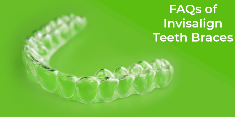 FAQs Of Invisalign Teeth Braces
