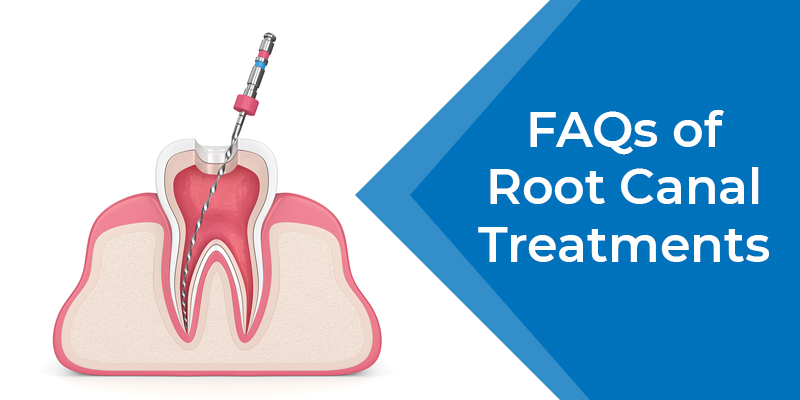 FAQs of Root Canal Treatment