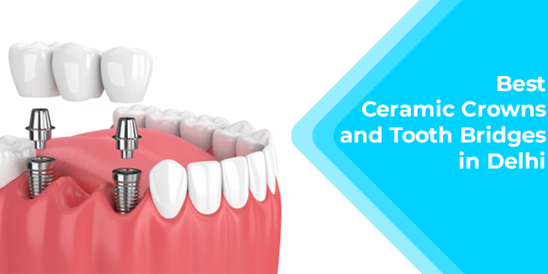 Ceramic Crowns And Tooth Bridges