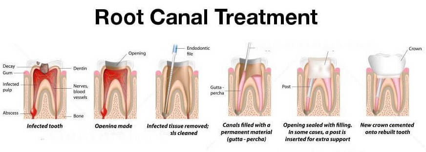 Painless Root Canal Treatment in india