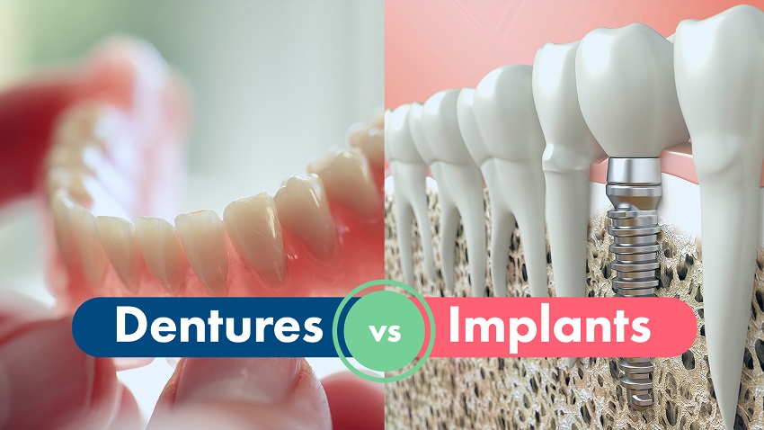 Denture Vs Dental Implant