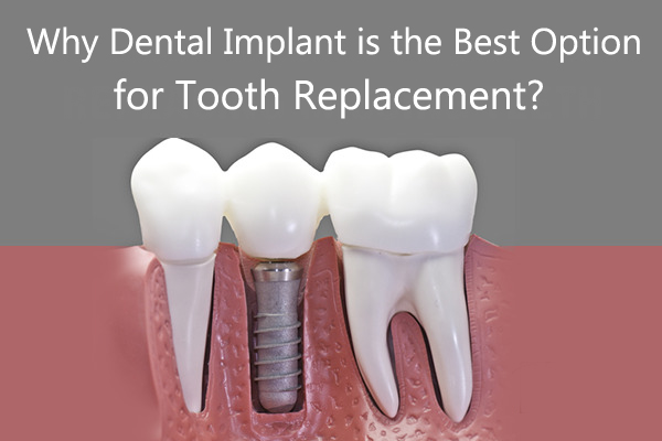 Best Dental Implant Clinic In India