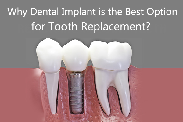 Best Dental Implant Clinic in India