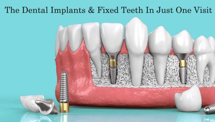 Dental Implants and Fixed Teeth In Just One Visit