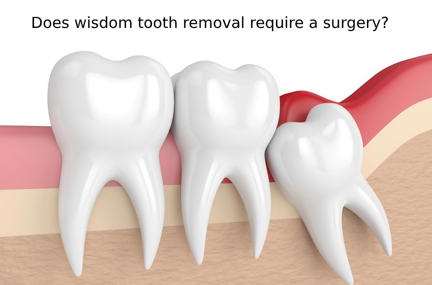 Wisdom Tooth removal