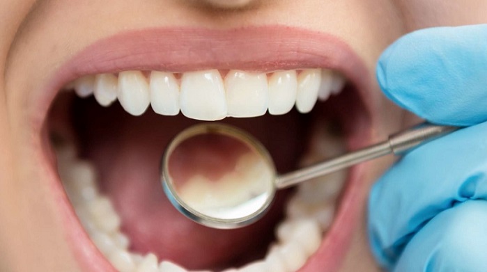 Cavities and tooth decay