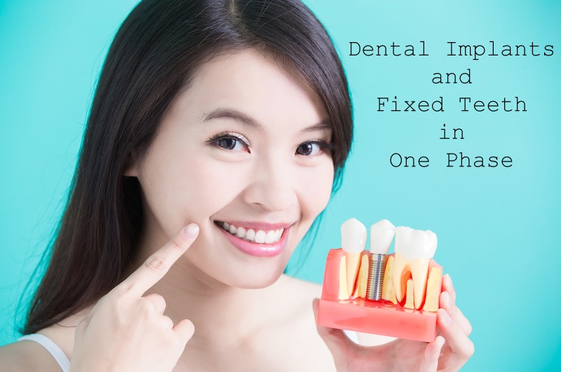 Dental Implants And Fixed Teeth In One Phase