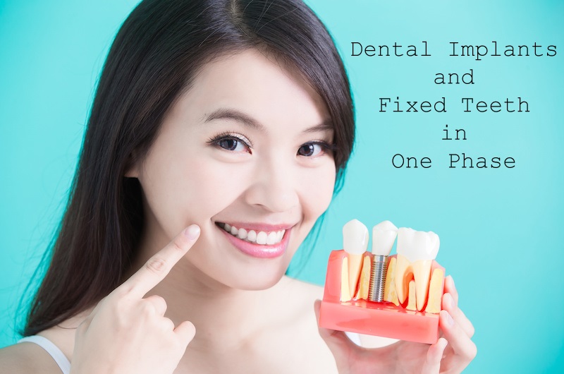 Dental Implants and Fixed Teeth in One Phase