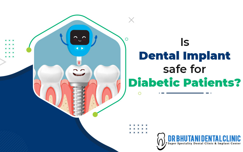 Dental Implants For Diabetic Patients