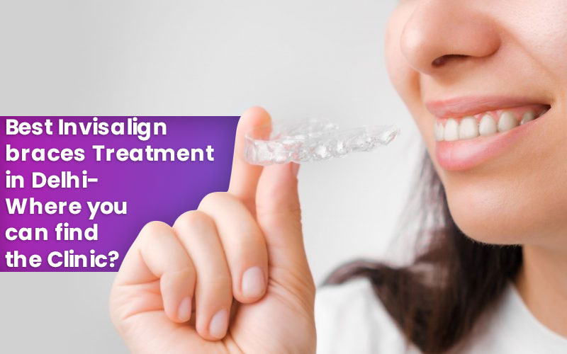 Invisalign braces treatment