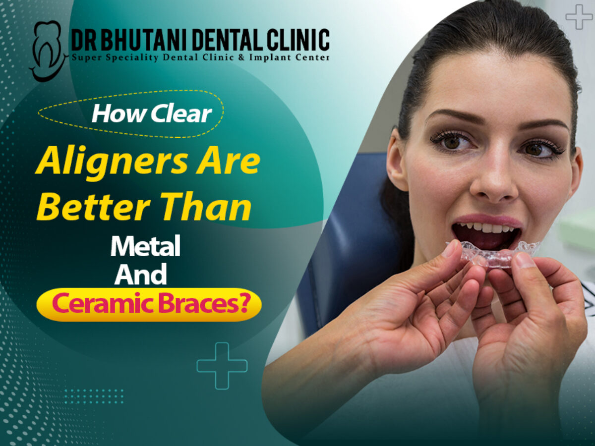 How Clear Aligners Are Better Than Metal And Ceramic Braces? Dr