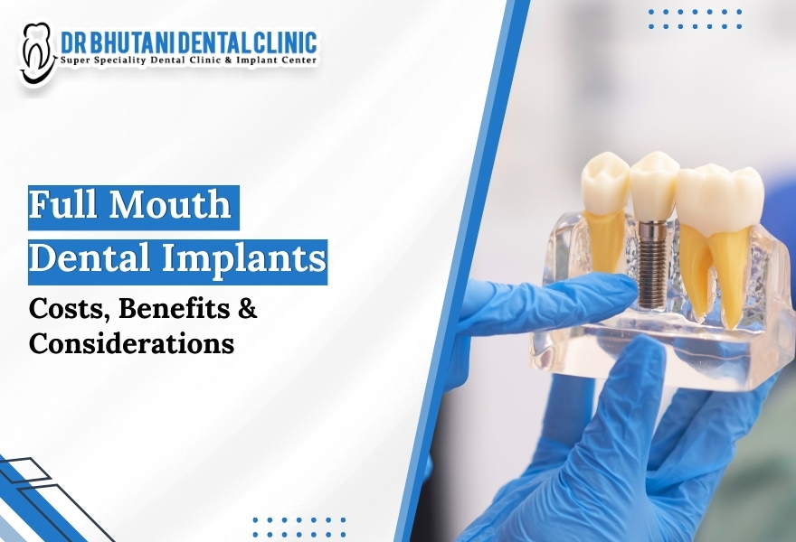 Full mouth dental implants