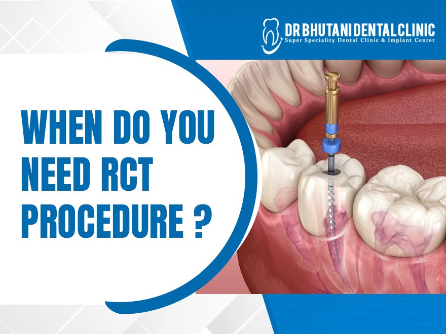 RCT Procedure