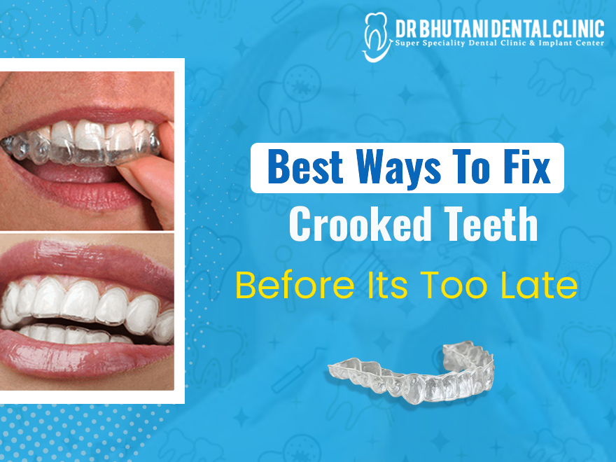 You Should Contact A Cosmetic Dentist Whenever You Want To fix Crooked Teeth Permanently.