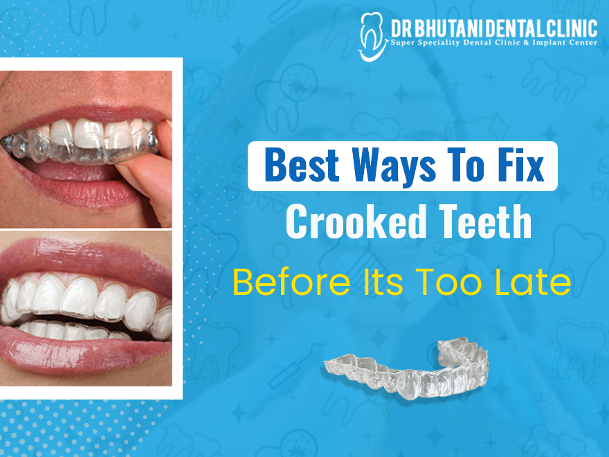 You should contact a cosmetic dentist whenever you want to fix crooked teeth permanently.