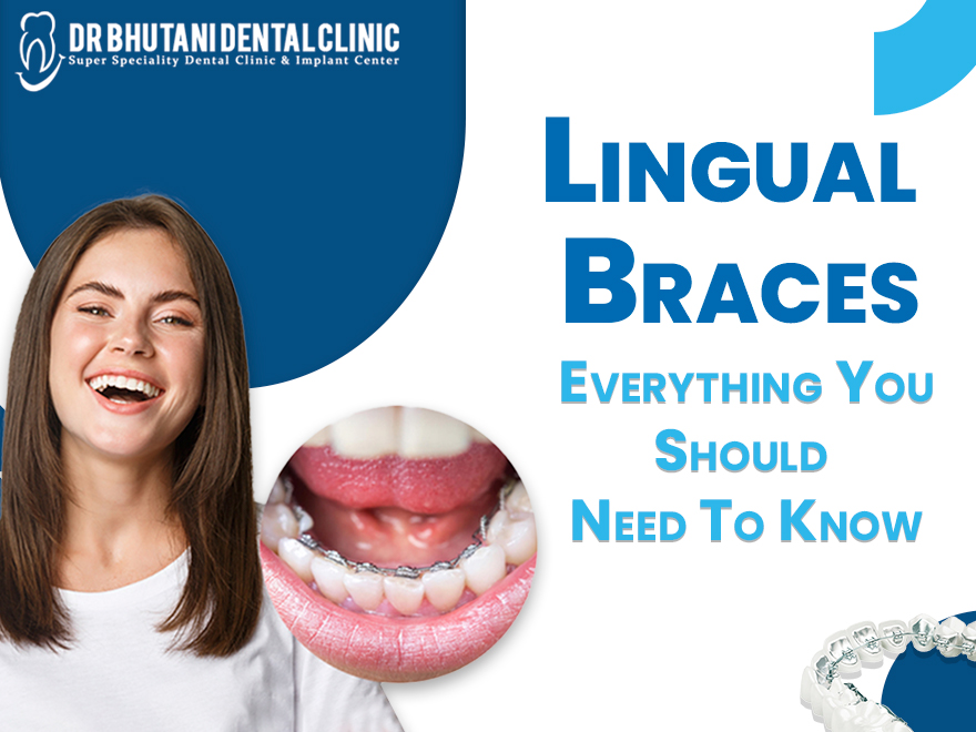 Lingual Braces Are Used To Give A Regular Shape To Your Teeth By Applying The Braces On The Inner Side.