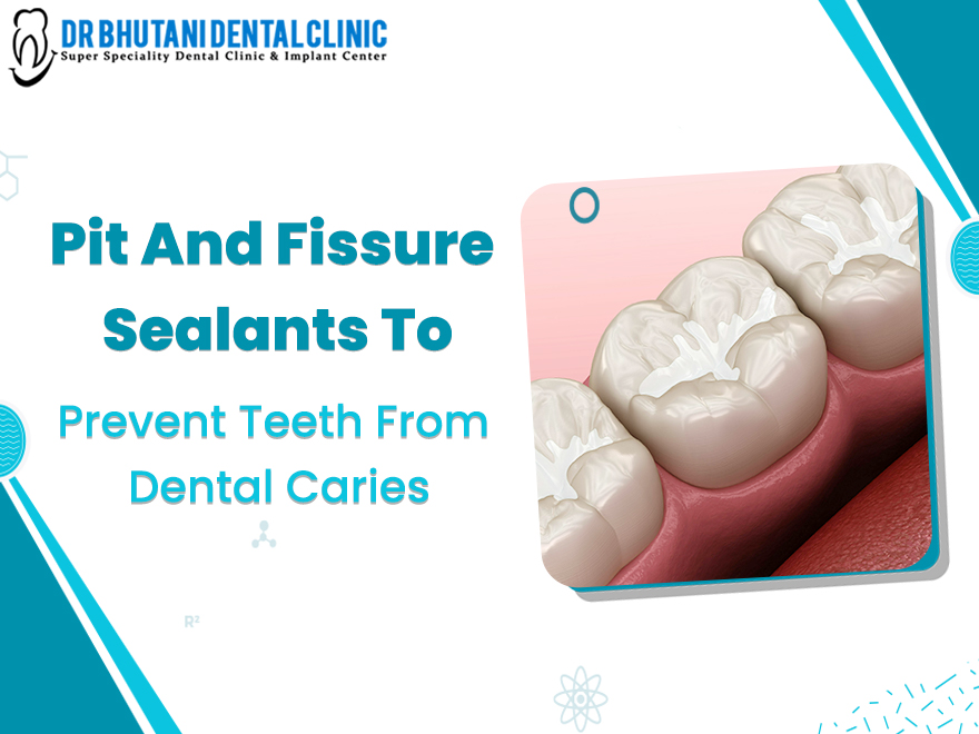 Pit And Fissure Sealants Are One Of The Best Panaceas To Cure The Cavities On The Teeth. In The Pits Of The Decayed Teeth, A Plastic Seal Is Applied To Prevent Bacteria And Food Particles.