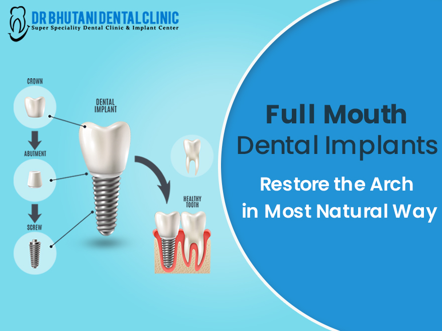 Full mouth dental implants