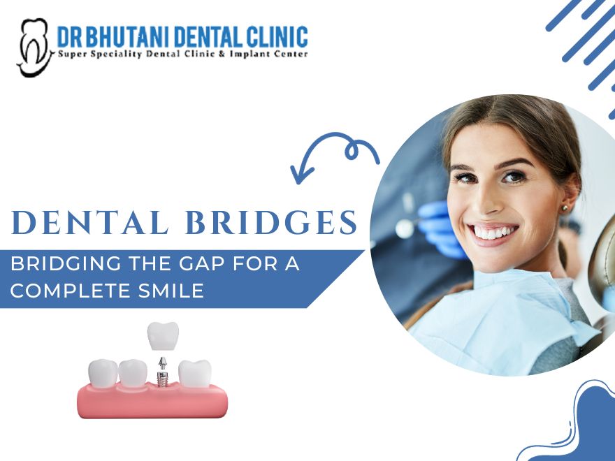 dental bridges