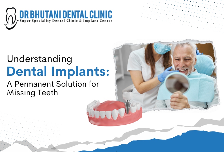 Full Mouth Dental Implants