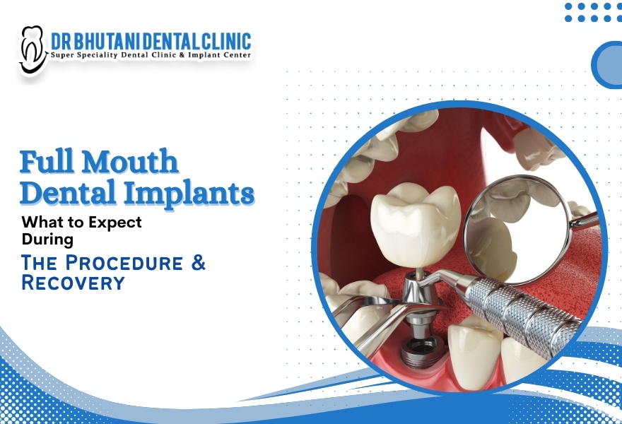 Full Mouth Dental Implants