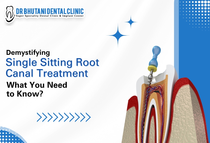 Root Canal Cost In India