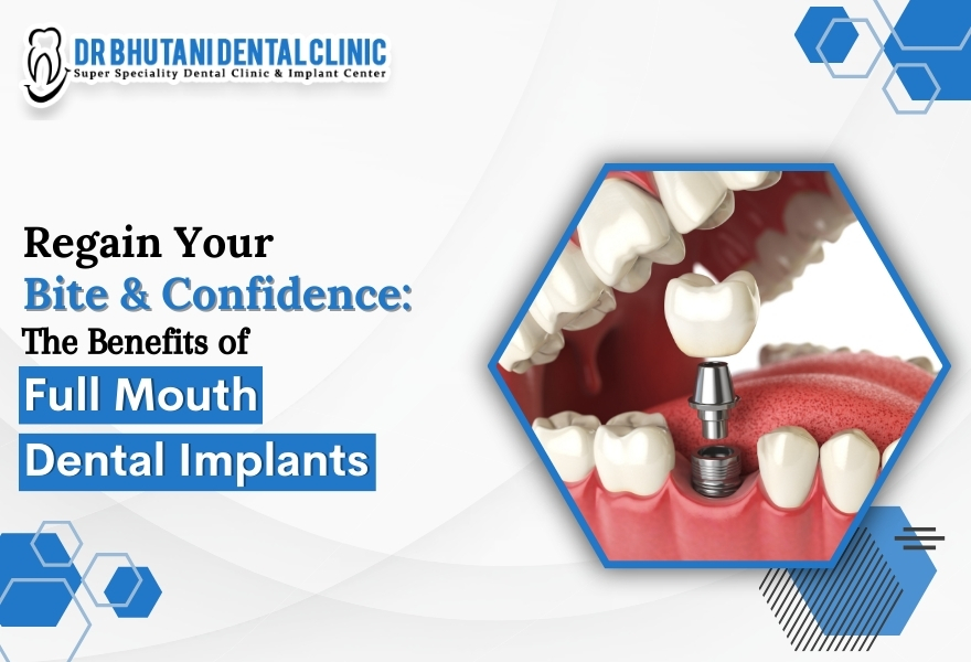 Full mouth dental implants