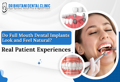 Do Full Mouth Dental Implants Look And Feel Natural Image