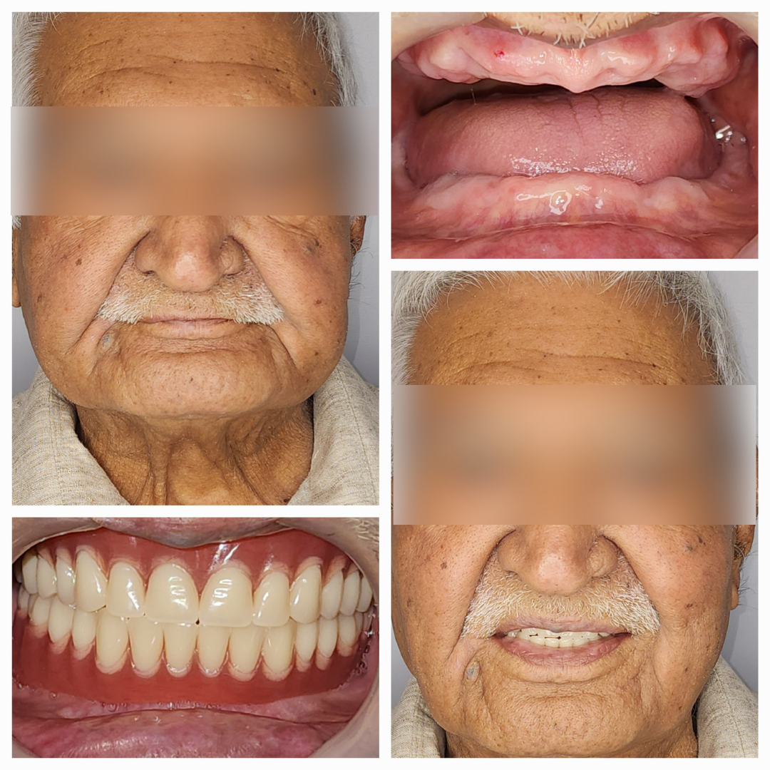 Single Sitting RCT for Dental Tourists: