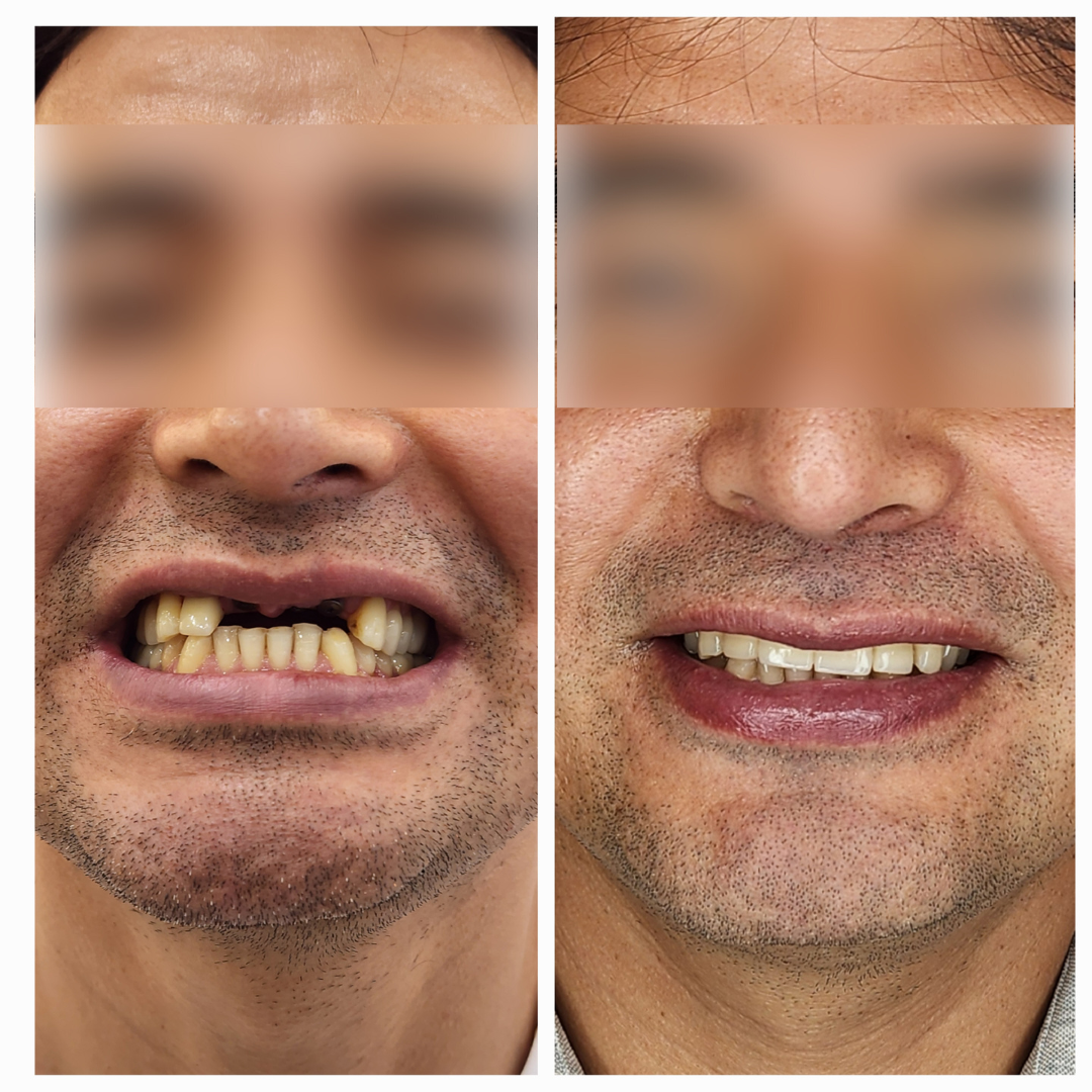 Single Sitting RCT for Dental Tourists