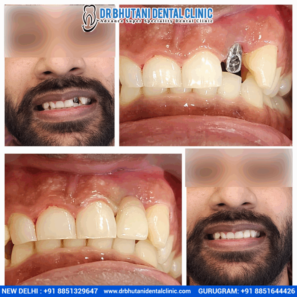 Single Sitting RCT: Amazing Before & After Patient Transformations